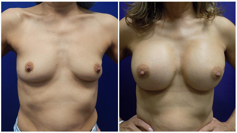 Bresat Augmentation using Implants